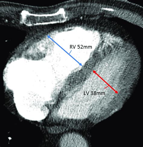 lv rv ratio|rv lv ratio pulmonary embolism.